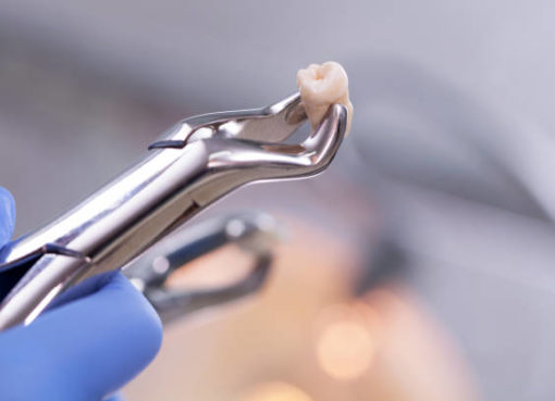 How much does tooth extraction cost?