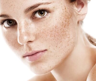 Learn why your skin is more Pigmentation and how to treat it